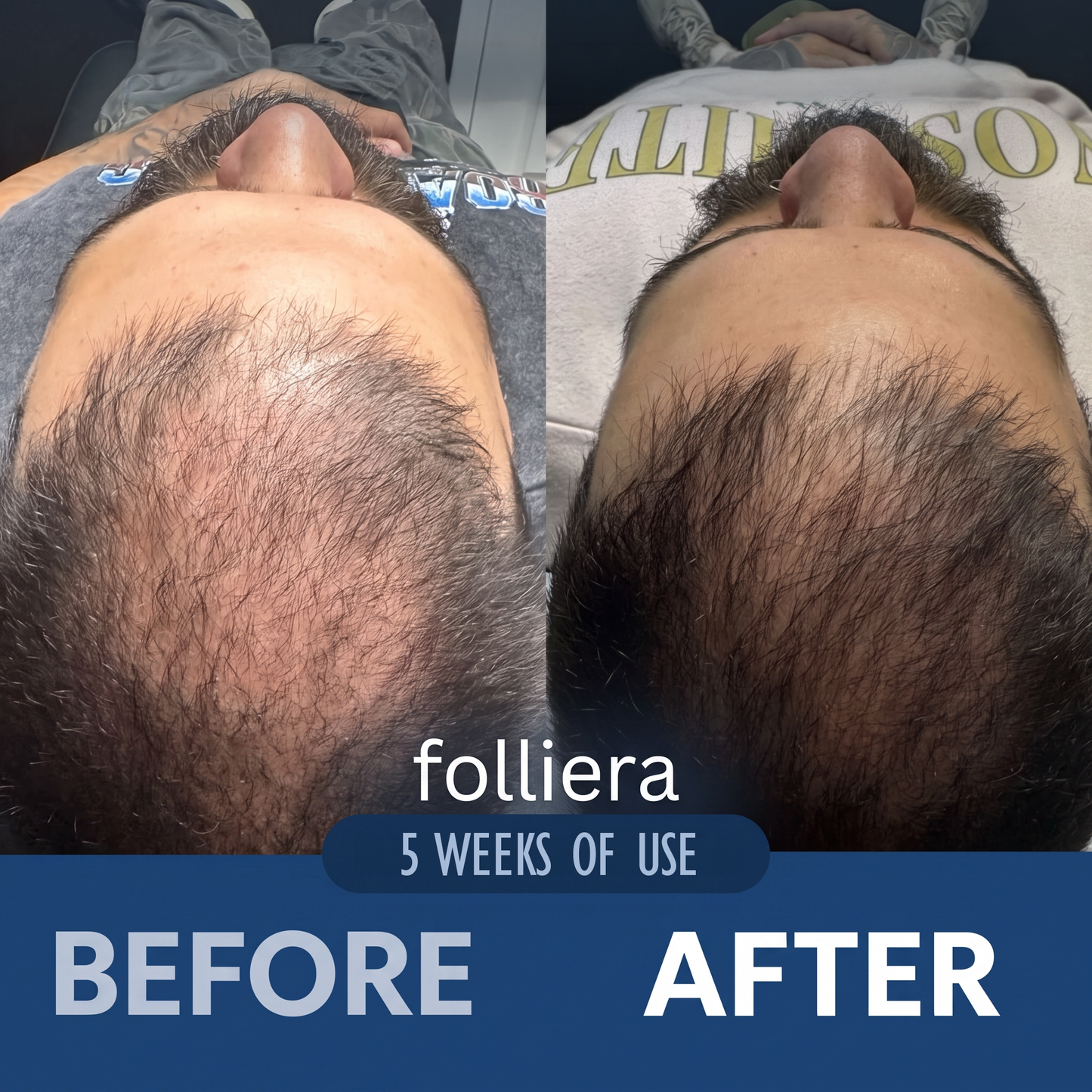 The Most Effective Peptide Infusion Hair Regrowth System