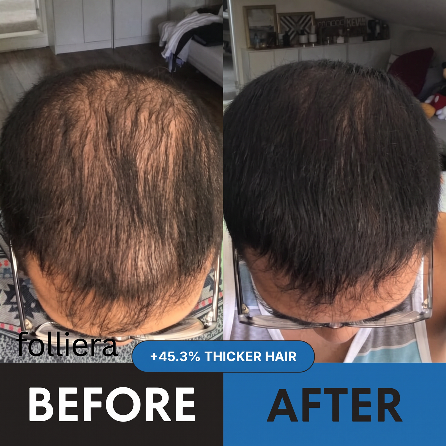 The Most Effective Peptide Infusion Hair Regrowth System