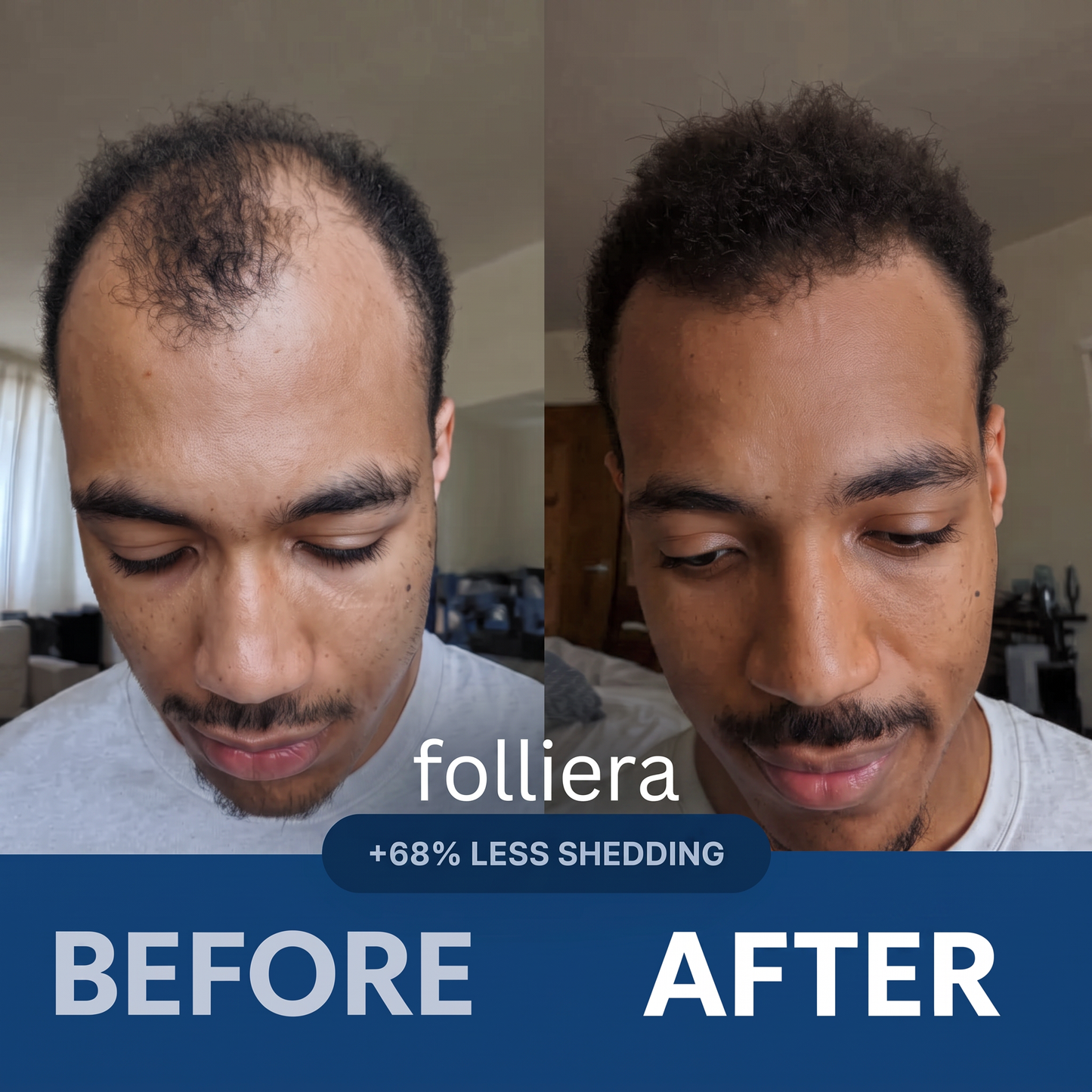 The Most Effective Peptide Infusion Hair Regrowth System